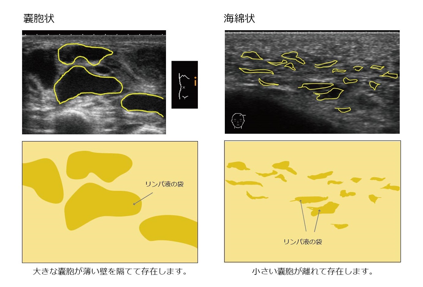 陰茎 硬化 性 リンパ 管 炎