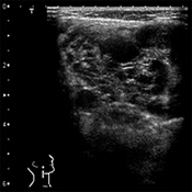 管 腫 リンパ リンパ管腫の診断・治療最前線 －小児外科－｜慶應義塾大学病院