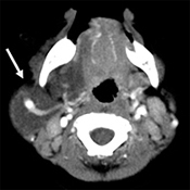 図2、右頚部リンパ管腫（造影CT）リンパ管腫部は黒っぽく見えます。この写真では内部に大きな血管が通っています。